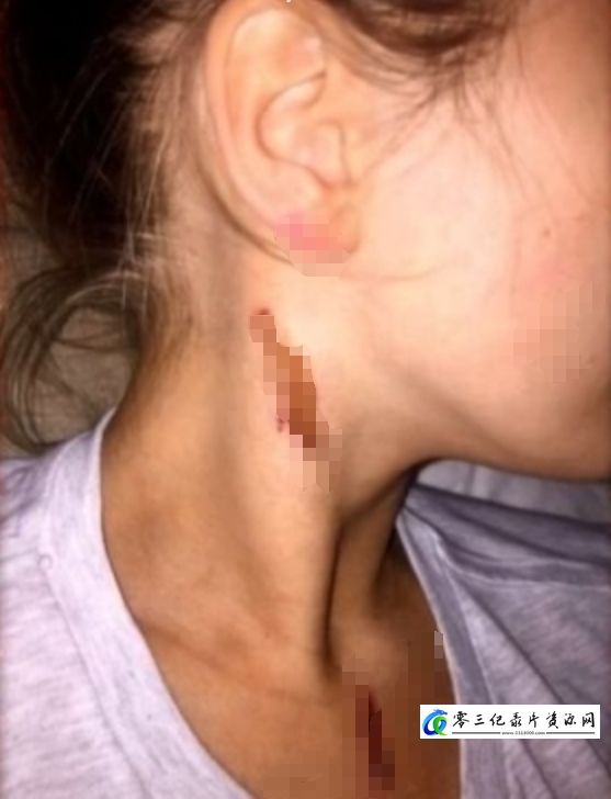 事件纪录片《英国泼酸袭击 Acid Attacks How Scared Should We Be》下载-零三纪录片资源网